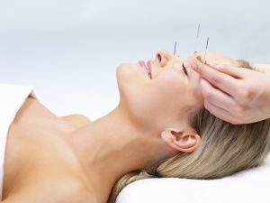 acupuntura-migrañas-recas